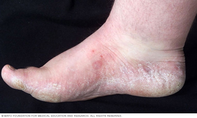 Athlete's foot case 4