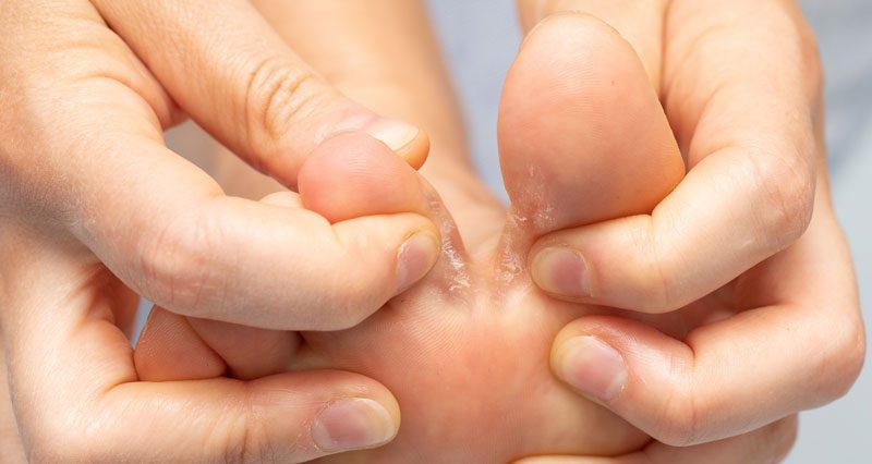 Athlete's foot case 1