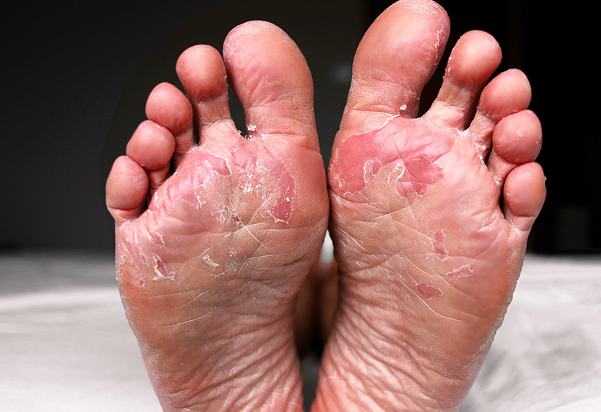 Athlete's foot case 2