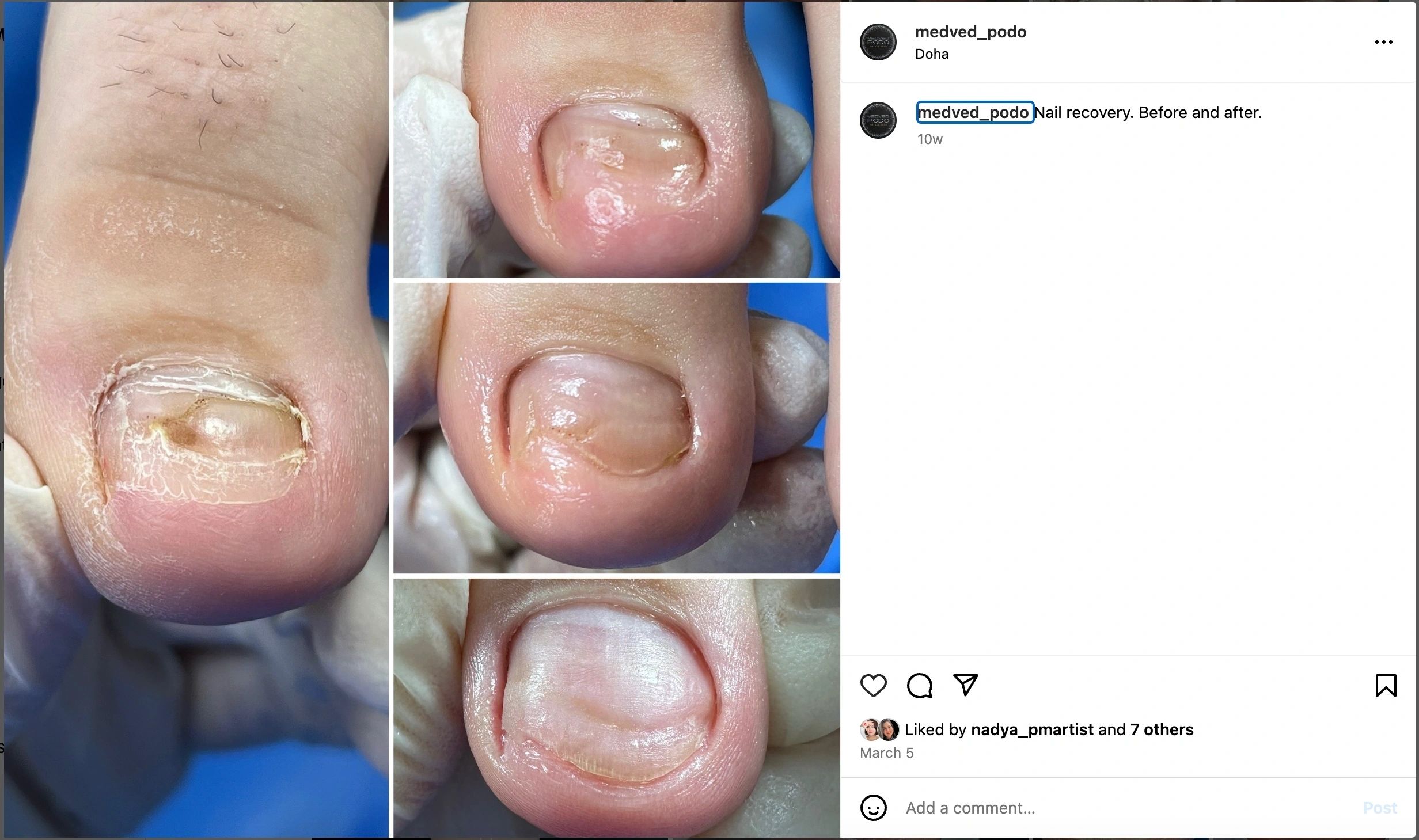 Before and after nail recovery at Medved Podo