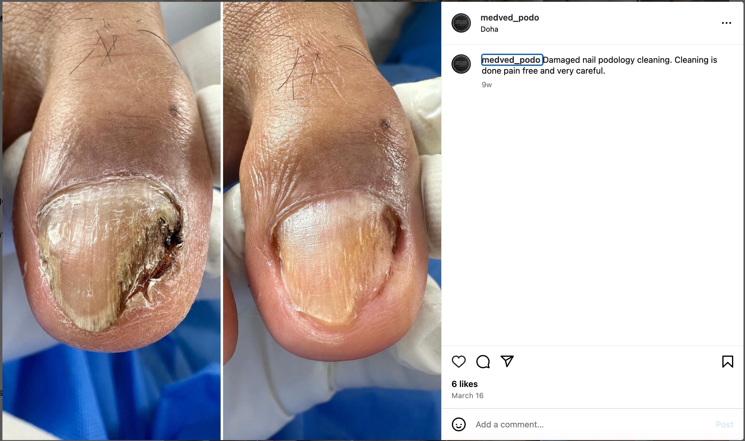 Before and after ingrown nail treatment