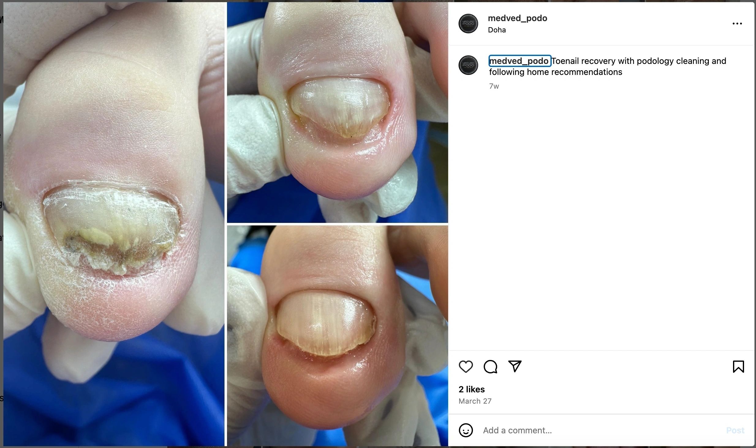 Before and after podology pedicure results