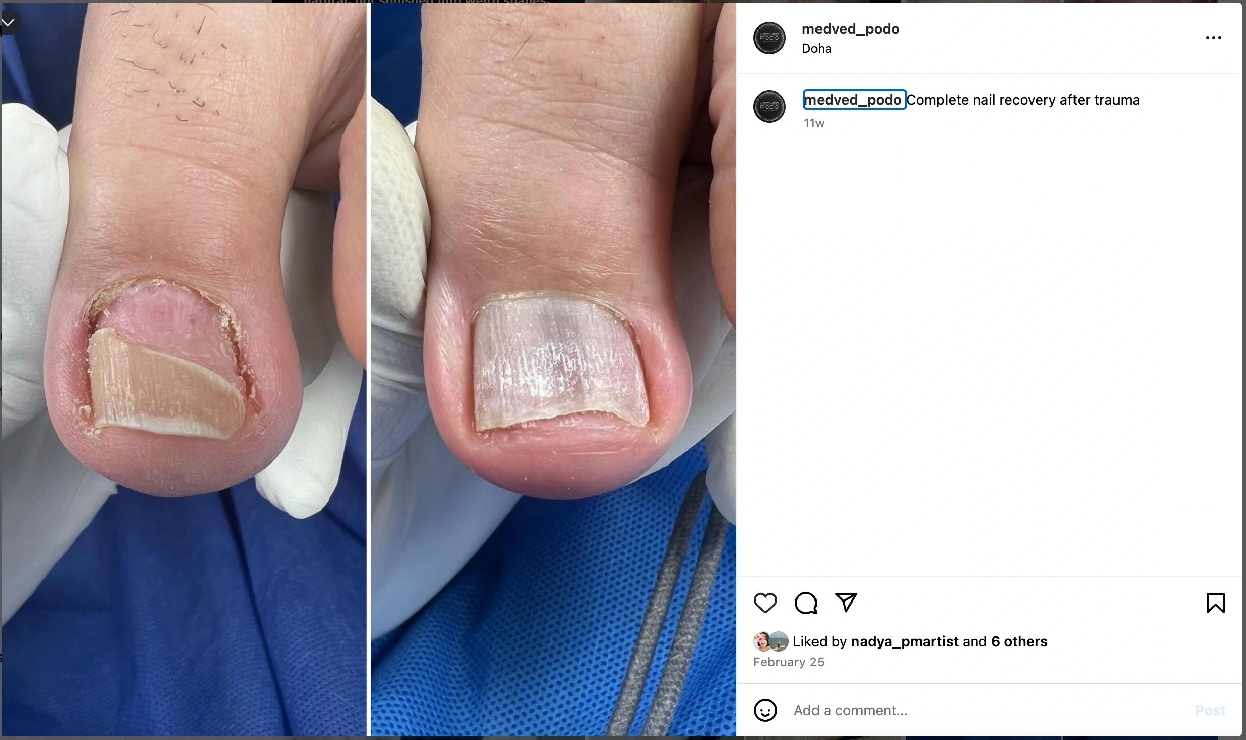 Before and after nail care results