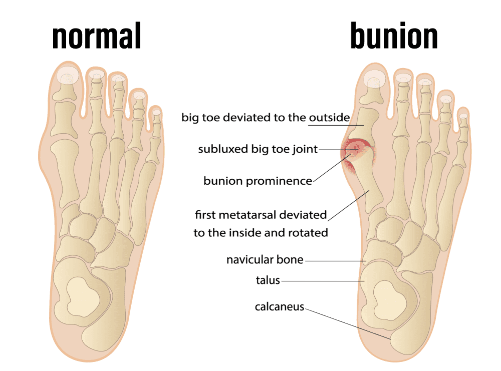 Bunion deformity diagram