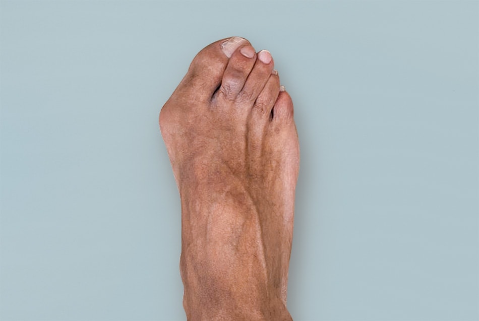 Progression of bunion deformity