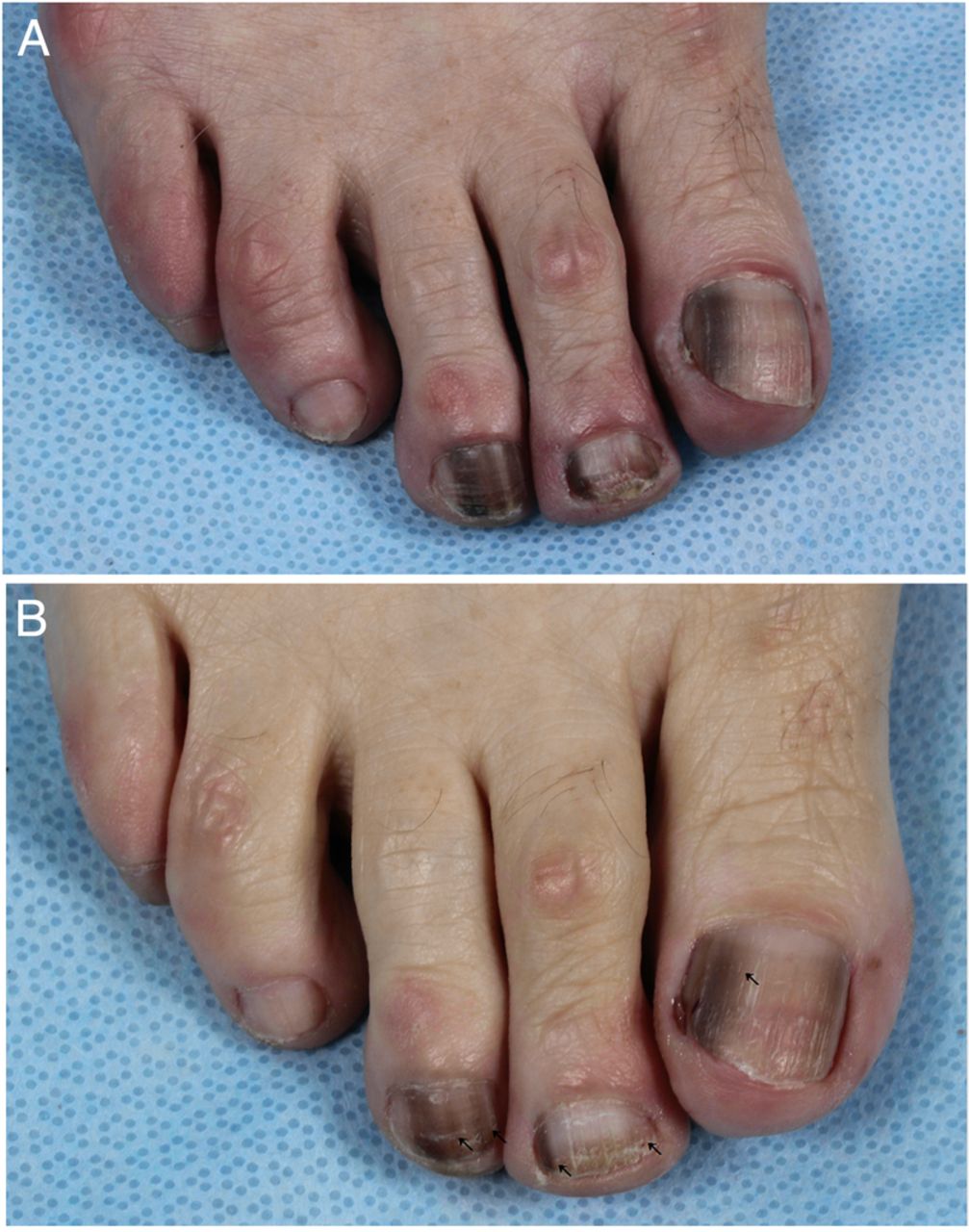 Dark nail pigmentation