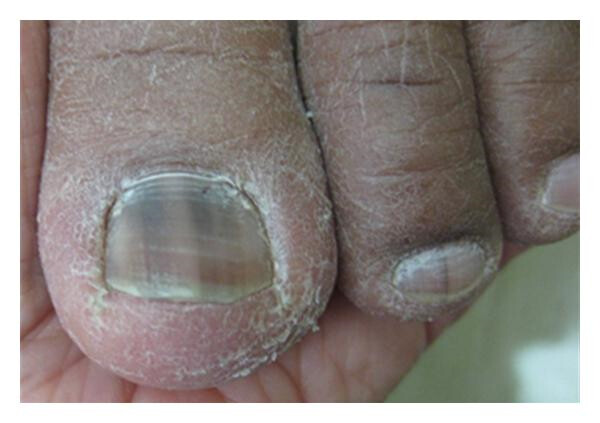 Vertical dark line on nail