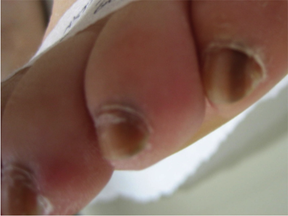 Melanonychia vs Melanoma differentiation