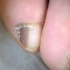 Melanonychia case study 1