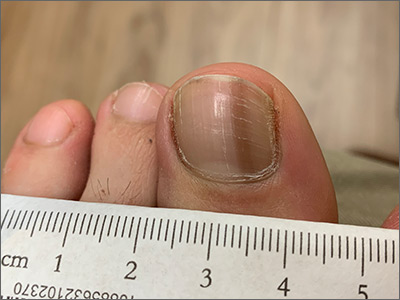 Melanonychia case study 2