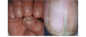 Vertically split nail condition