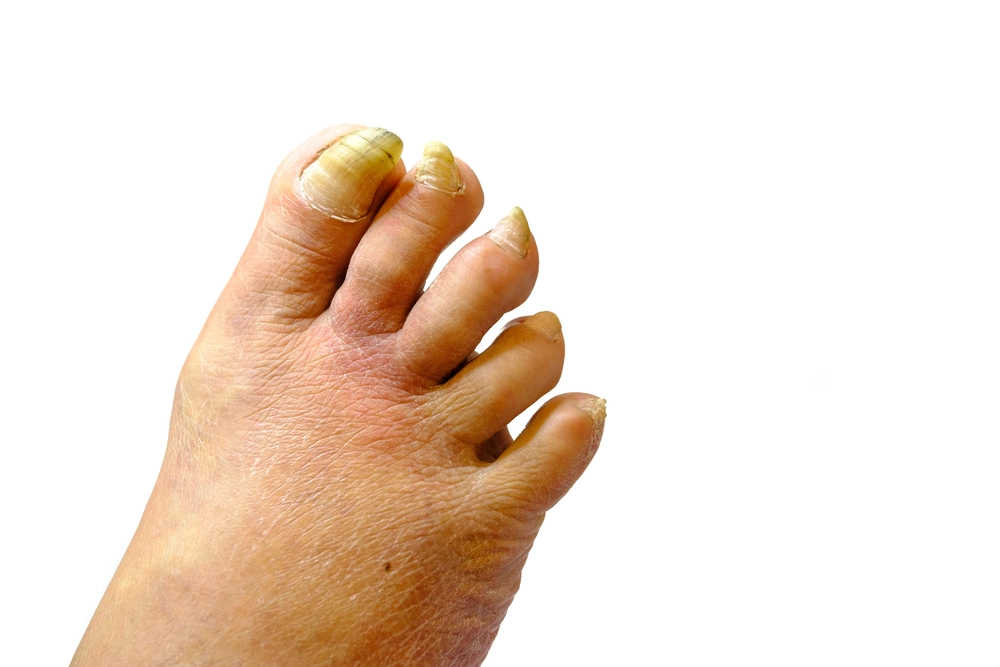 Onychogryphosis presentation