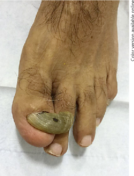 Thickened claw-like nail