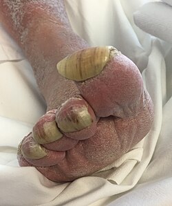 Thickened, curved nail plate