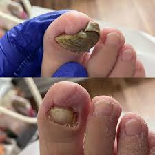 Claw-like nail case study