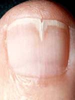 Vertically split nail close-up