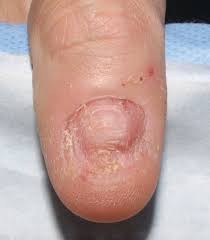 Onychotillomania nail ridges condition