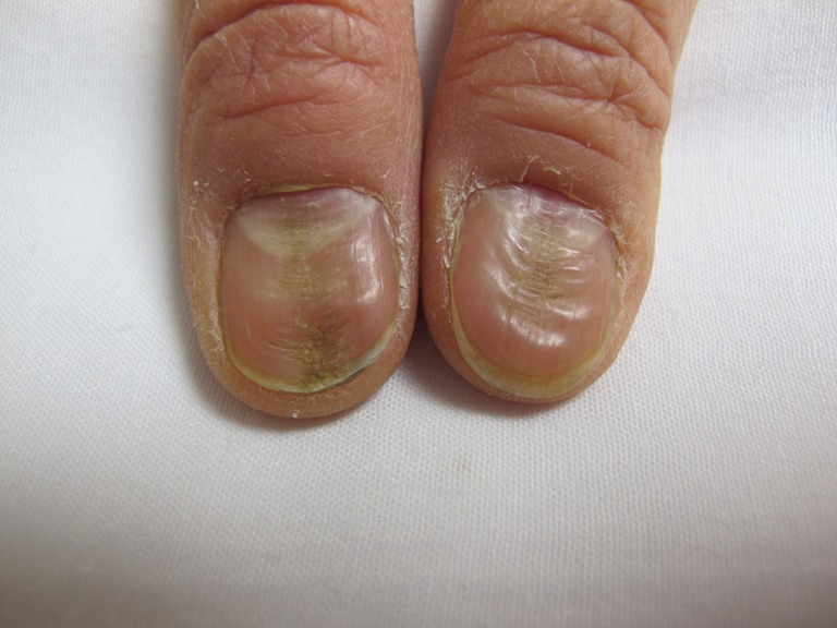 Onychotillomania nail detail