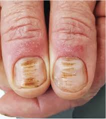 Signs of onychotillomania — ridges and grooves on nails